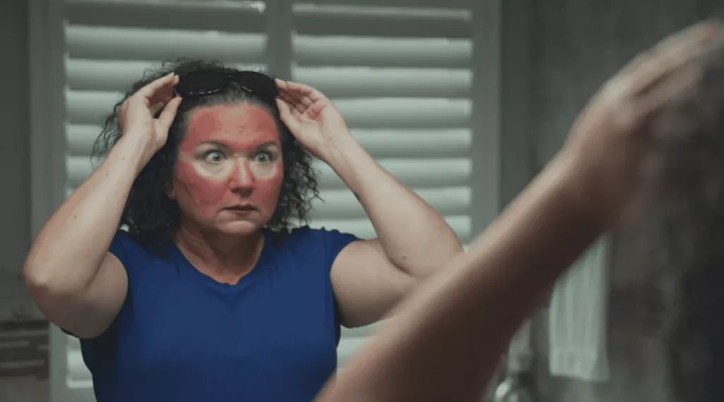 Woman with severe sun burn from not wearing sunscreen realizes the extent of her mistake
