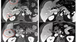 TIL liver mets