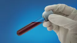 Guardant Health anuncia los resultados de su estudio sobre análisis de sangre para detectar cáncer colorrectal