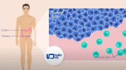 What is Immunoscore?