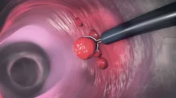 A colorectal polyp being removed by a colonoscope's snare. 