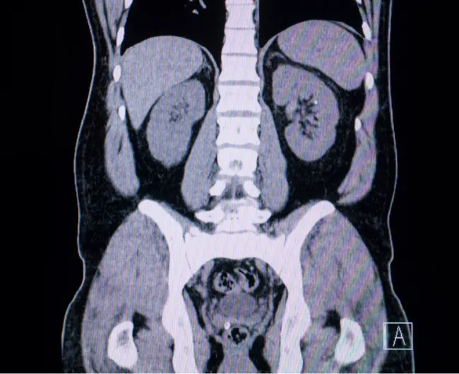 Recurrence Timeline Image 1 - CT scan