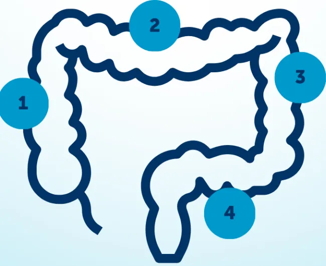Sidedness | Colorectal Cancer Alliance