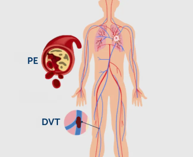 vte_diagram