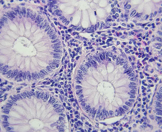 cancer cells round blue