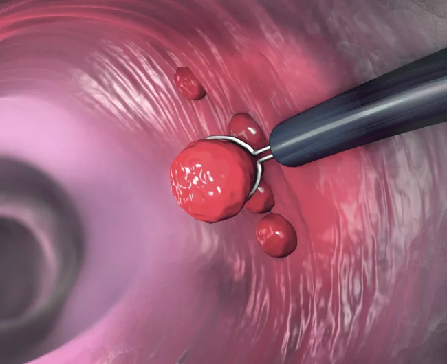 A colorectal polyp being removed by a colonoscope's snare. 