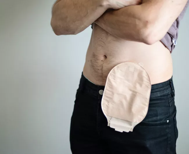 man with ostomy bag