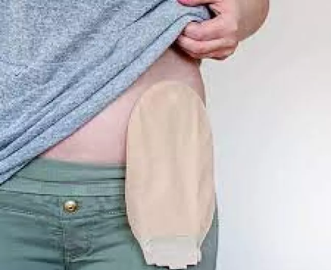 woman with ostomy bag 