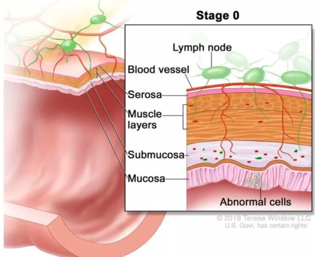 stage 0 colorectal cancer illustration