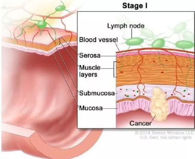 illustration of stage I colorectal cancer 