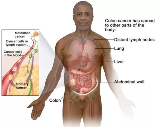 illustration of stage IV colorectal cancer in the body