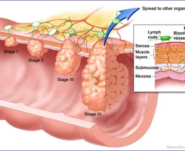 illustration of cross section of colon cancer in all stages