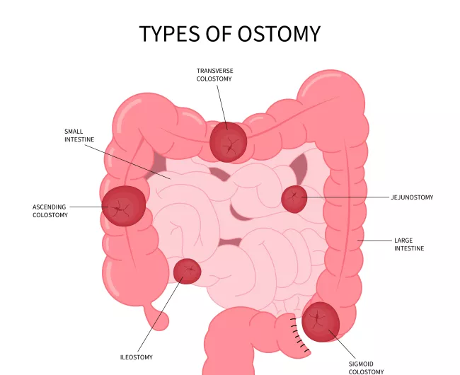 types of ostomy diagram 