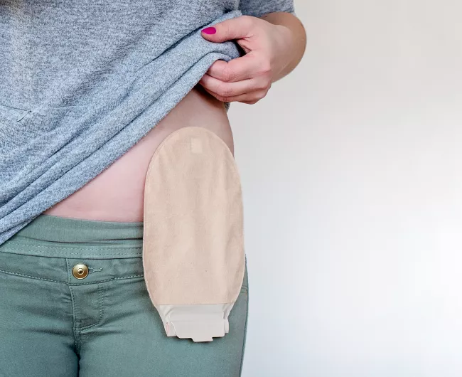 woman in green with ostomy